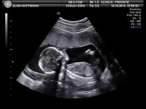 download lagu mp3 mp4 Ultrassom, download lagu Ultrassom gratis, unduh video klip Ultrassom