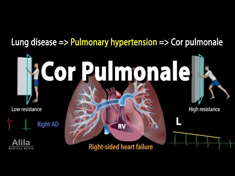 Atrial Septal Defect ASD Animation