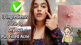 3 Ingredients to Dry Out Pus Filled Acne| How to Treat Pus filled Acne #skincare #glowingskin #acne