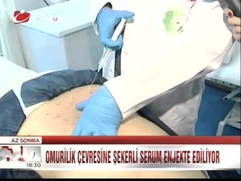 Uzm. Dr. İlker Solmaz - Kanaltürk Ana Haber - Bel Fıtığı Tedavisi 16.12.2013