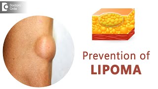 Prevent Lipomas From Occurring | Fatty Lump | Fatty Tumor - Dr. Sahebgowda Shetty | Doctors