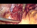 Step By Step Laparoscopic Surgery For Endometriosis- Dr Jay Mehta