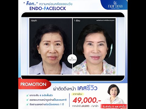ผ่าตัดดึงหน้า ยกกระชับรูปหน้า ด้วย ENDO - FACELOCK ที่ นารดาคลินิก