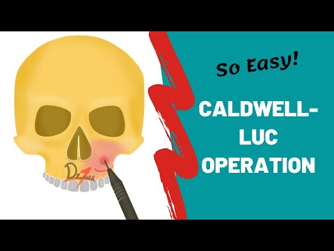 Operacja metodą Caldwell-Luc | Chirurgia stomatologiczna