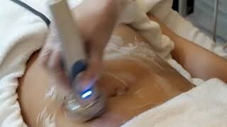 Remove excess fat in your stomach | Avignon Mesobiolift RF