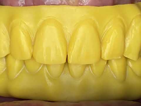 Neodent Neoarch Immediacy All on a 6 Tilted