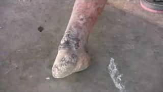 preview picture of video 'Visiting a leper at her home http://damientheleper.org'