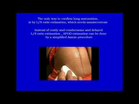 Clinical Applications Of Amniotic Fluid Optical Density (AFOD) In Obstetric Practice (Part- III)