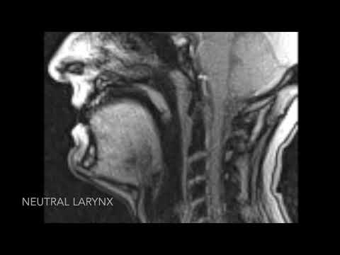 MRI Laryngeal Movement