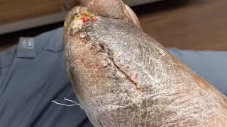 CASE UPDATE: THE GANGRENOUS TOE / PARTIAL FOOT AMPUTATION AND MAYBE ANOTHER ON THE WAY 😢😢😢😢