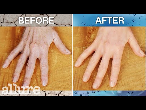 Doctor Explains How Hand Filler Works | Allure