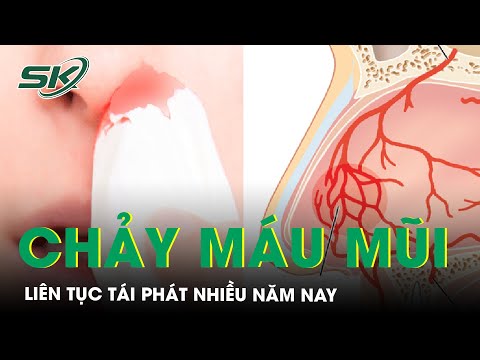 Chảy Máu Mũi Tái Phát Nhiều Năm Do Các Dị Dạng Mạch Hốc Mũi | SKĐS