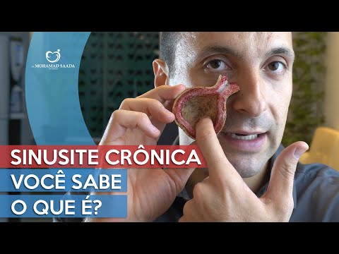Chronic Sinusitis: Learn What it is, How to Treat it, Symptoms and More