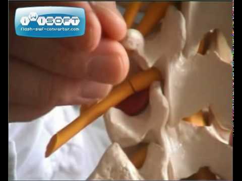 PRT - periradikuläre Therapie