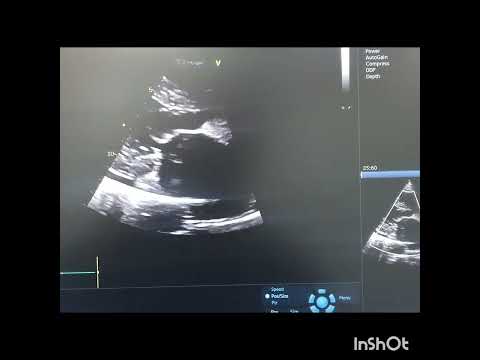 Flial Mitral Valve with severe MR