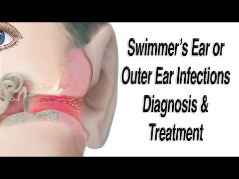 Outer Ear Infections, aka Swimmer's Ear Infections, Acute Otitis Externa: Diagnosis and Treatment