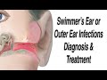 Outer Ear Infections, aka Swimmer's Ear Infections, Acute Otitis Externa: Diagnosis and Treatment