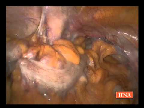 Wie man Prostata-Adenom zu Hause behandeln Bienenprodukte und deren Verwendung zur Prostata