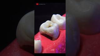 Download lagu This is an indirect dental restoration: ONLAY #dentist #satisfying mp3 Download lagu This is an indirect dental restoration: ONLAY #dentist #satisfying mp3