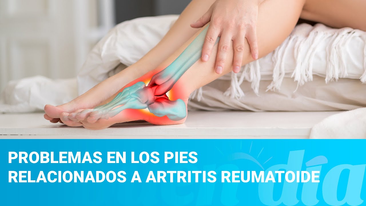 Problemas en los pies relacionados a artritis reumatoide