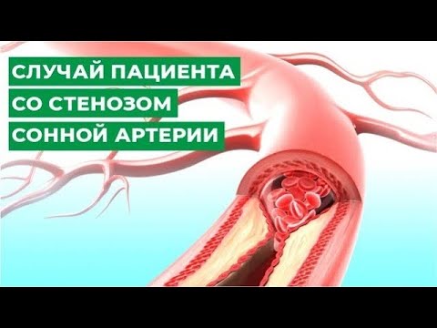 Случай пациента со стенозом сонной артерии