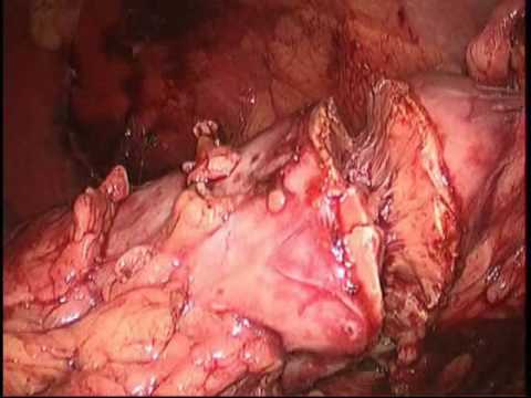 Left Laparoscopic Partial Nephrectomy - Part 2