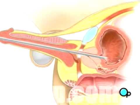 PreOp® Patient Education Cystoscopy Male Surgery 2