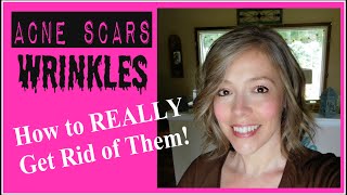 How to Really Get Rid of Wrinkles and Acne Scars