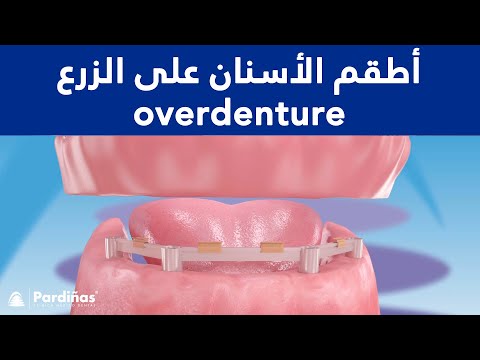 أطقم الأسنان على الزرع «overdenture» ©