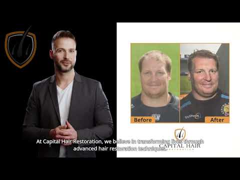Videos from Capital Hair Restoration