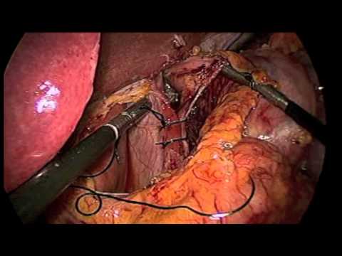 Bypass żołądka - rewizja laparoskopowa
