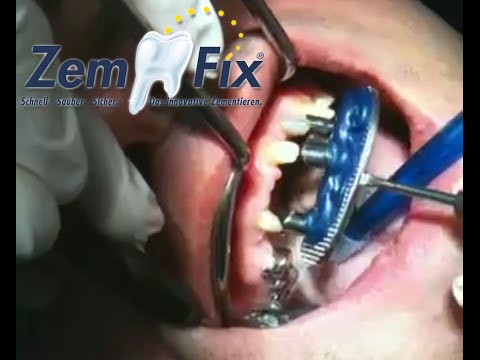 Live-Praxis!: 10 Teleskopkronen in 5 Minuten zementieren mit ZemFix®