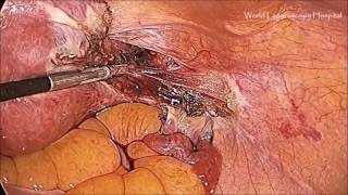 Total Laparoscopic Hysterectomy with RoBi and Ultrasonic Dissector