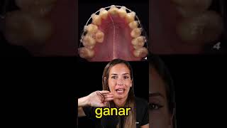 ¡Mira como se mueven los dientes con los brackets! ¡Increíble time lapse ortodoncia!