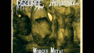 HAEMORRHAGE - Reamputated