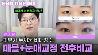눈두덩이가 너무 두꺼워서 고민이라면?🤔  | 눈성형 ONE 하니?