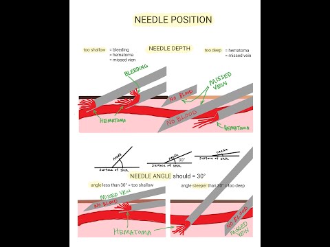 Venipuncture - How to Position a Needle
