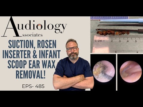 SUCTION, ROSEN INSERTER & INFANT SCOOP EAR WAX REMOVAL - EP485