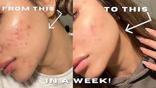 GETTING RID of my ACNE SCARRING IN A WEEK