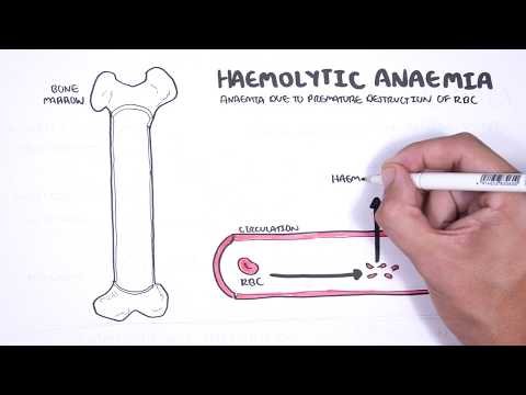 Haemolytic Anaemia - classification (intravascular, extravascular), pathophysiology, investigations