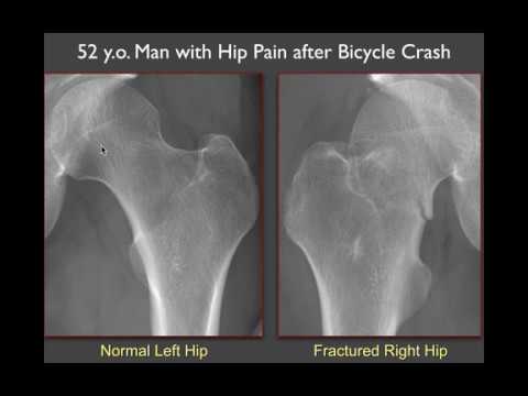 hip osteoporosis 1 fokozatú kezelés)