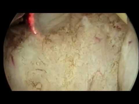 Se sia possibile per la prostatite avere formaggio Come trattare le pietre della prostata