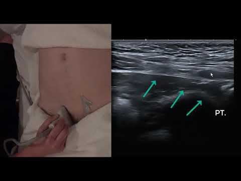 Ultrasound femoral and inguinal hernia video recording 21M hernia