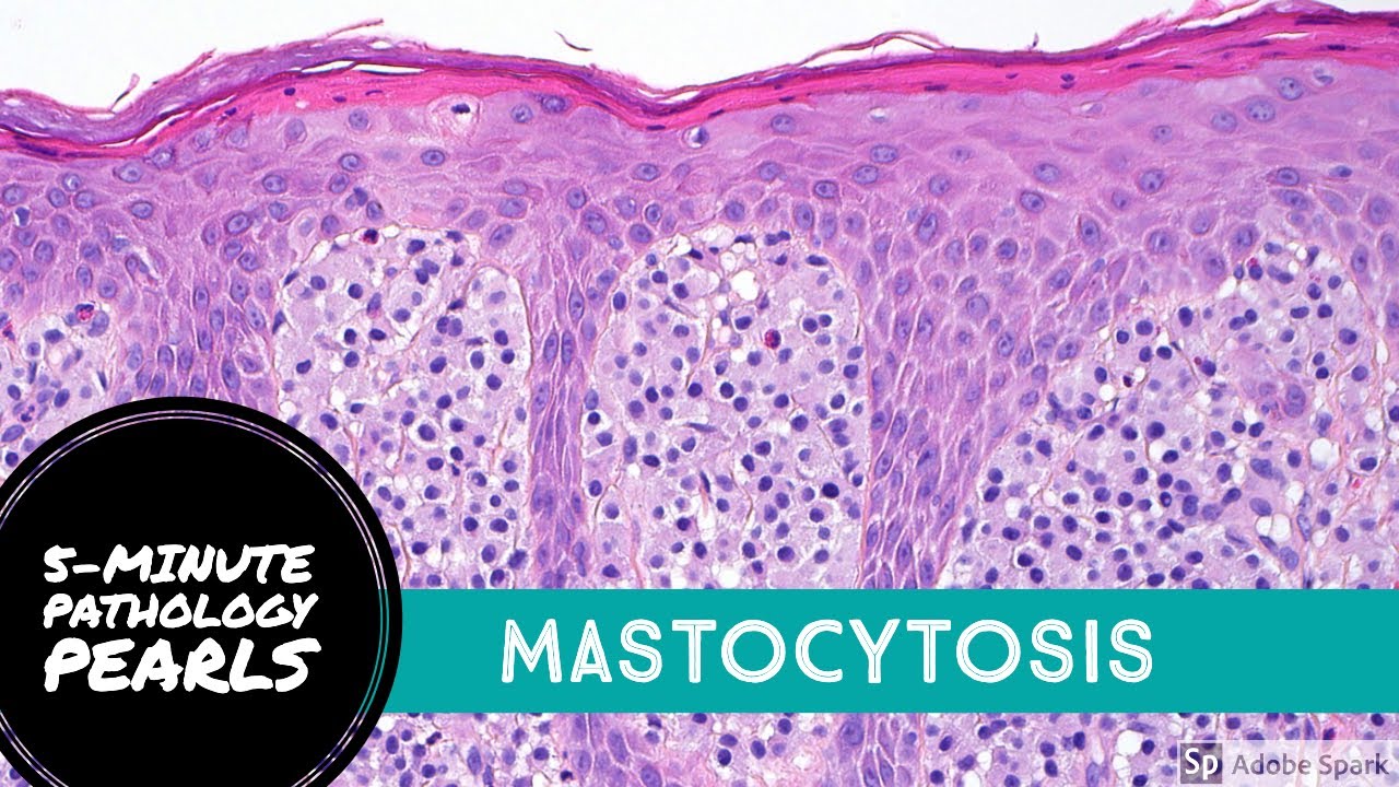 Mastocytosis (Urticaria Pigmentosa): 5-Minute Pathology Pearls