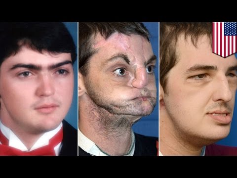 Face transplant recipient Richard Norris meets donor family that gave him a new life - TomoNews