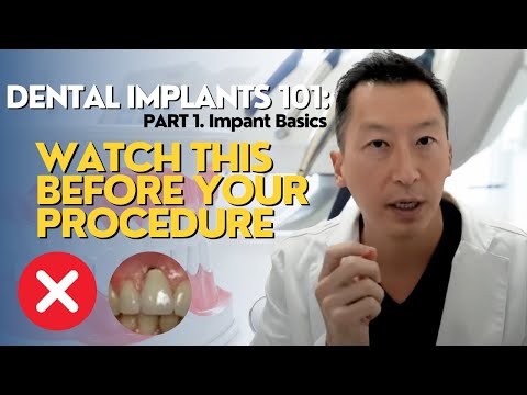 Dental Implants: What You Need to Know! Part 1 (Implant Basics)