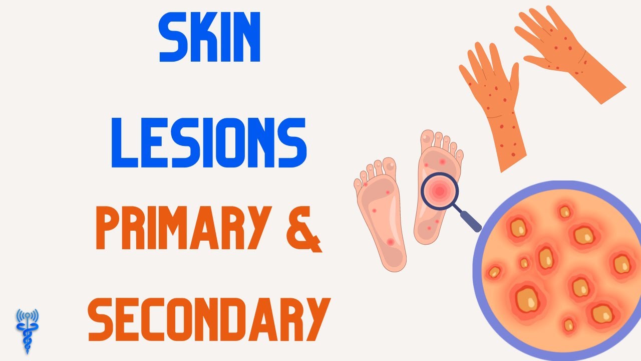 SKIN LESIONS | Primary & Secondary
