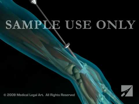 Endoscopic Carpal Tunnel Release Procedure