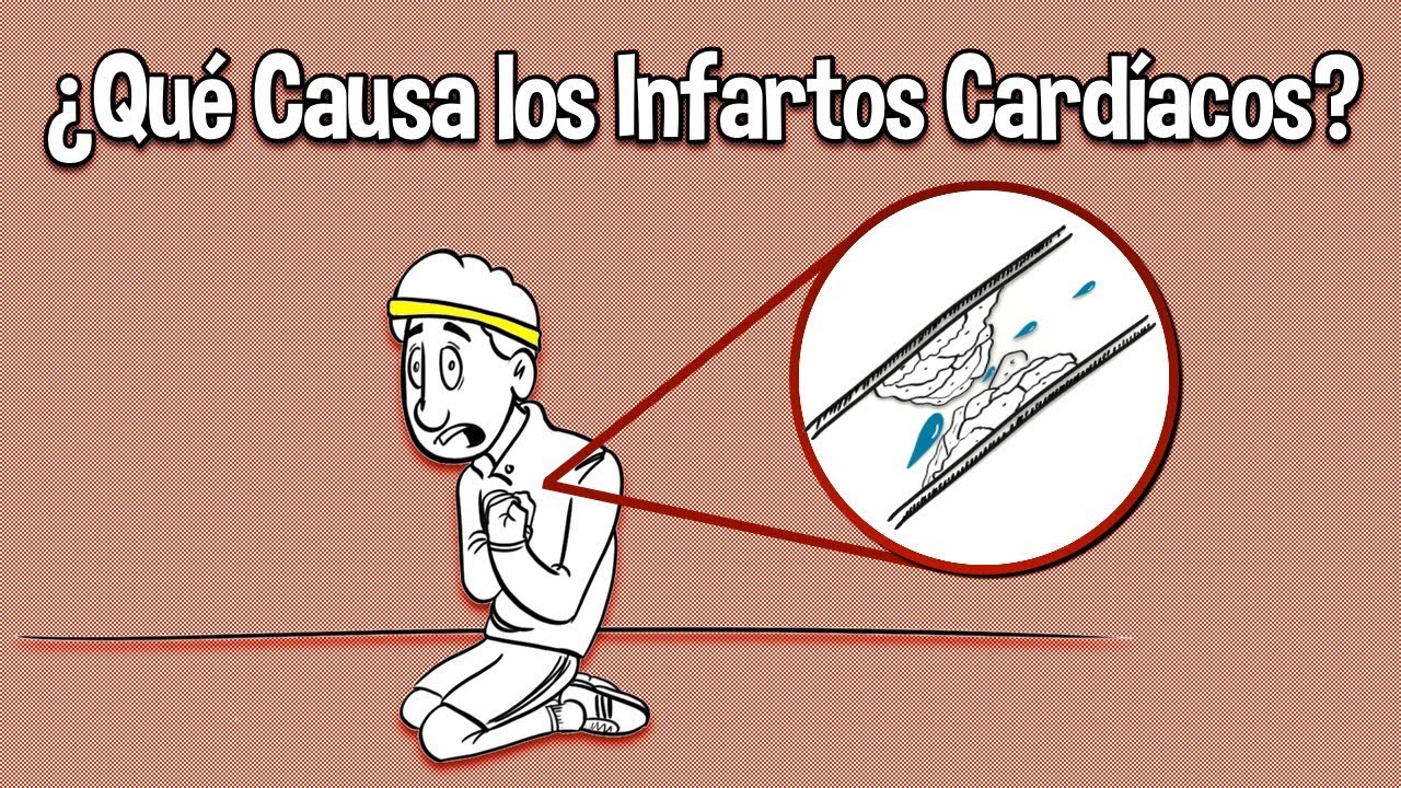 ¿Que Causa los Infartos Cardiacos