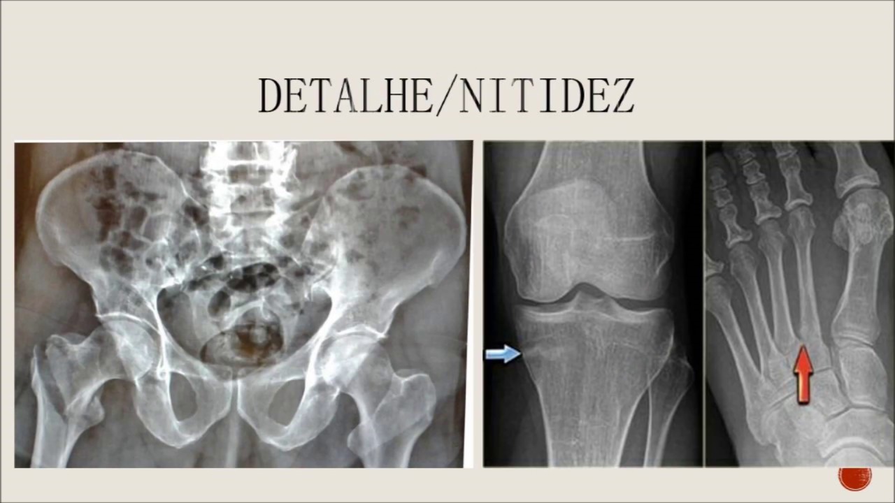 Qualidade Radiográfica